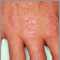 Dermatomyositis, Gottron's papules on the hand