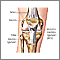 Anterior cruciate ligament repair - series
