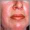 Dermatomyositis, heliotrope rash on the face